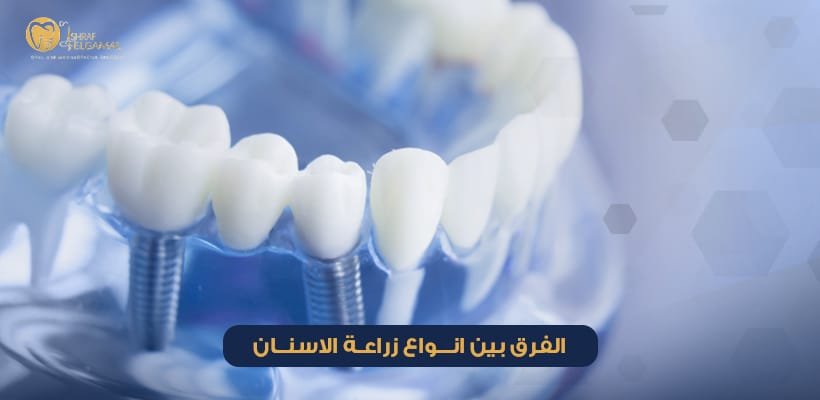 انواع زراعة الاسنان