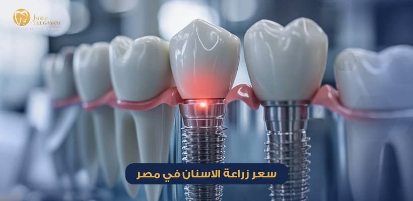 سعر زراعة الاسنان