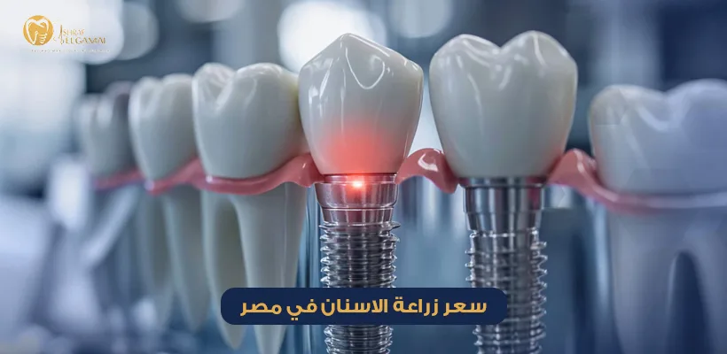 سعر زراعة الاسنان