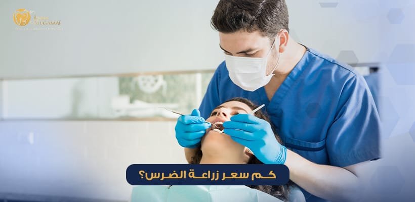 سعر زراعة الضرس