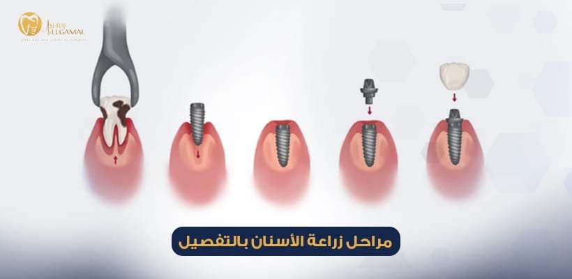 مراحل زراعة الأسنان