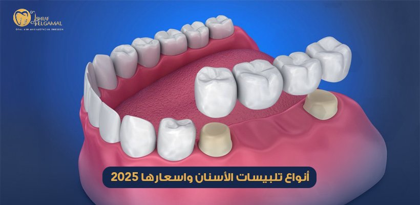 أنواع تلبيسات الأسنان واسعارها