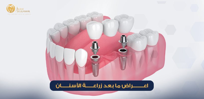 اعراض ما بعد زراعة الأسنان