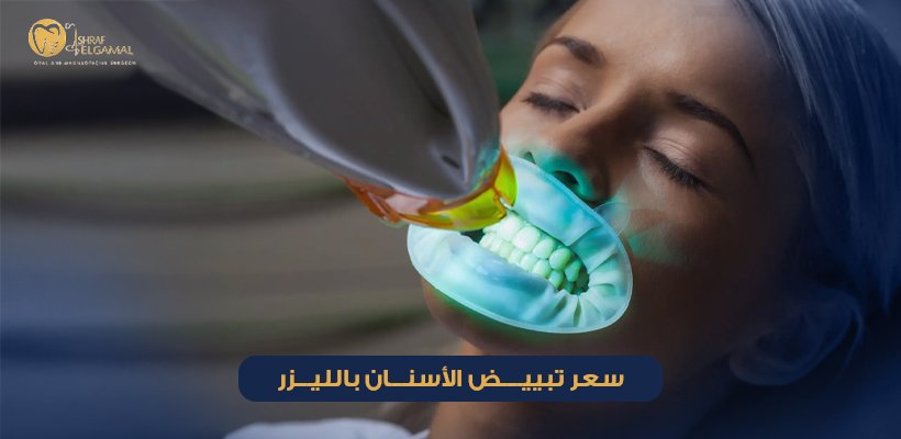 سعر تبييض الأسنان بالليزر