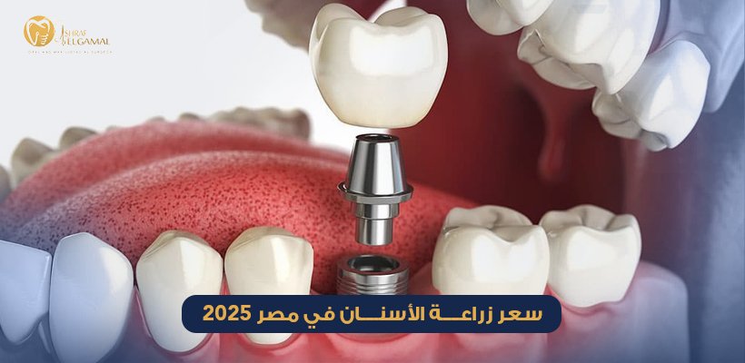 زراعة الأسنان الفورية