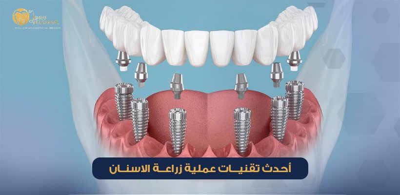 عمليه زراعه الاسنان