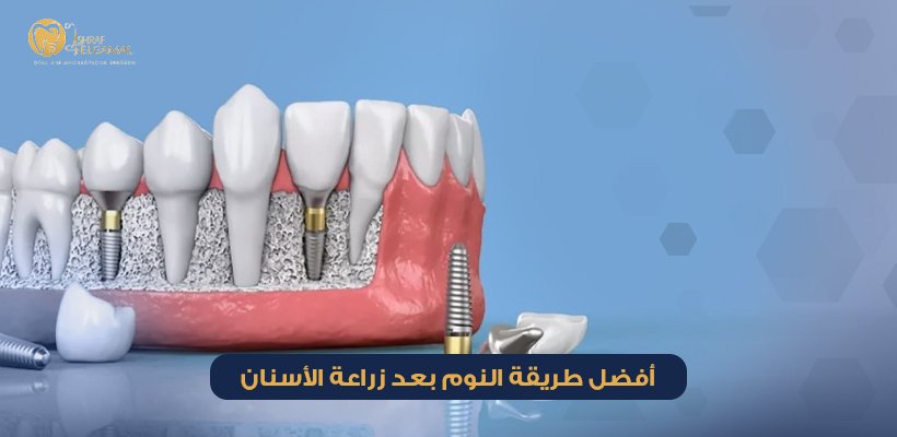 طريقة النوم بعد زراعة الأسنان