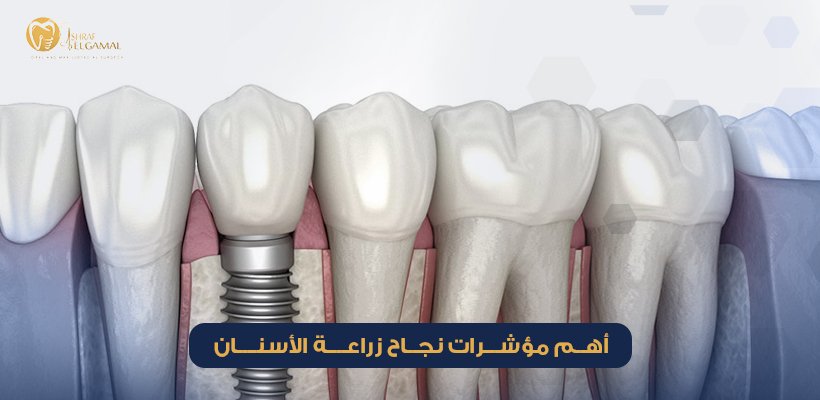 كيف اعرف نجاح زراعة الأسنان