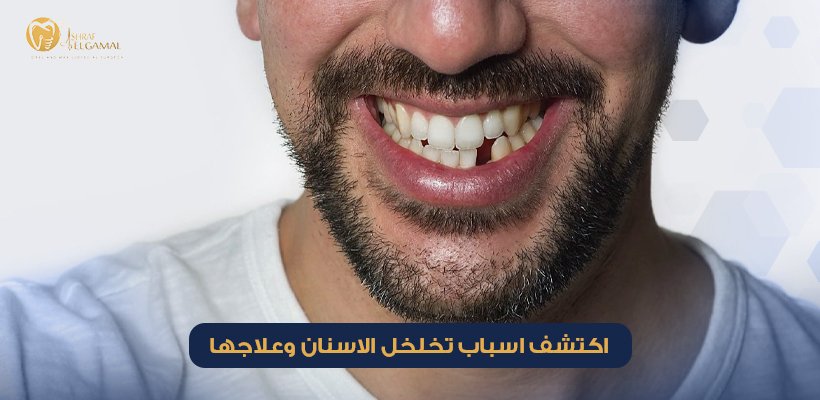 اسباب تخلخل الاسنان