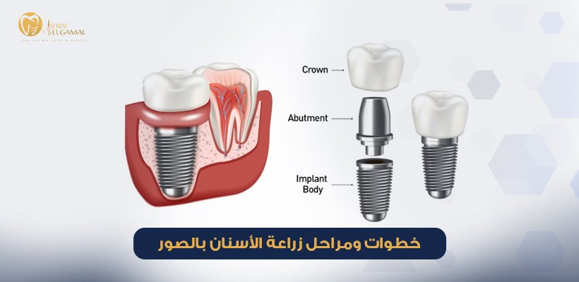 مراحل زراعة الأسنان بالصور