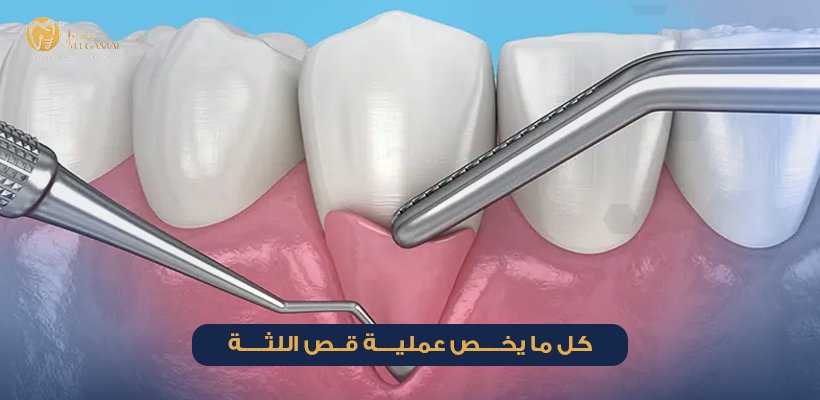 عملية قص اللثة