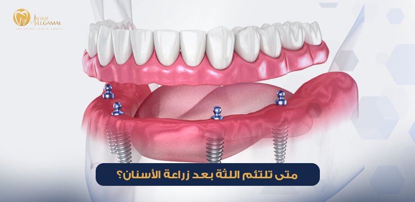 متى تلتئم اللثة بعد زراعة الأسنان