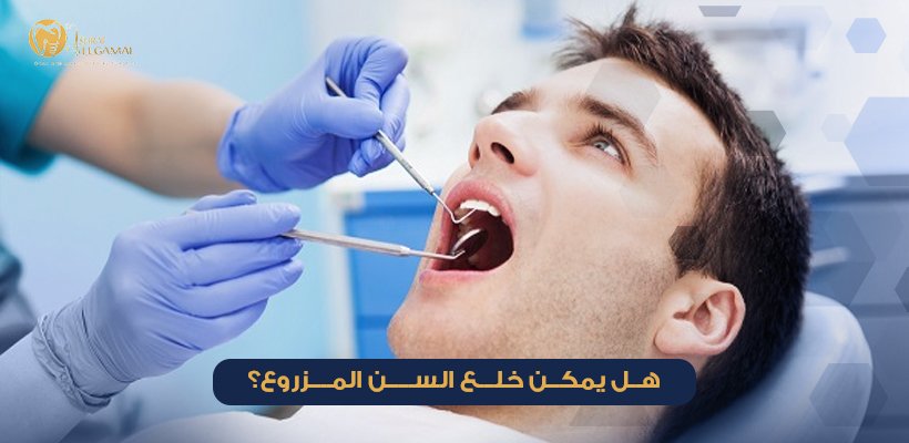 هل يمكن خلع السن المزروع