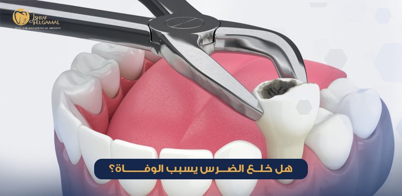 هل خلع الضرس يسبب الوفاة