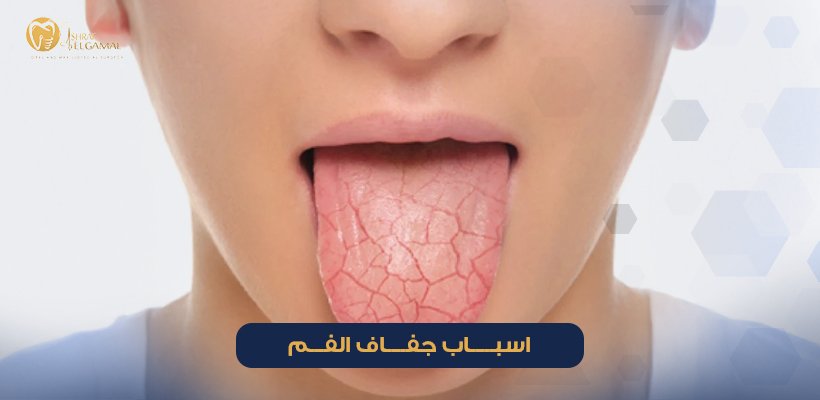 اسباب جفاف الفم
