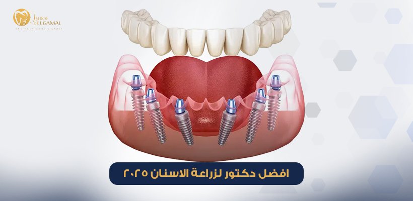 افضل دكتور لزراعة الاسنان