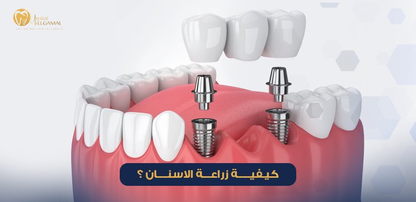 كيفية زراعة الاسنان
