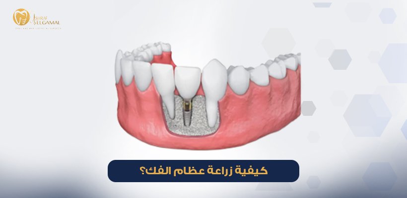 زراعة عظام الفك