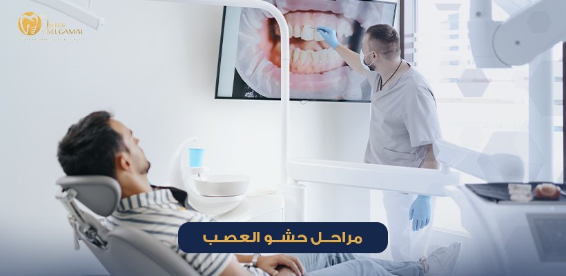 مراحل حشو العصب