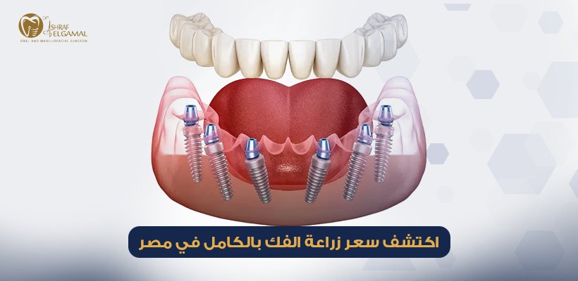 سعر زراعة الفك بالكامل في مصر