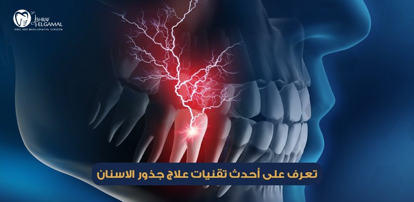 علاج جذور الاسنان