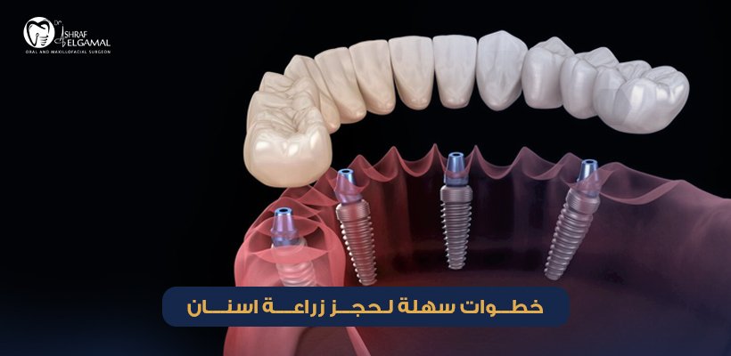 حجز زراعة اسنان