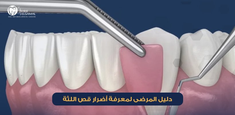 أضرار قص اللثة