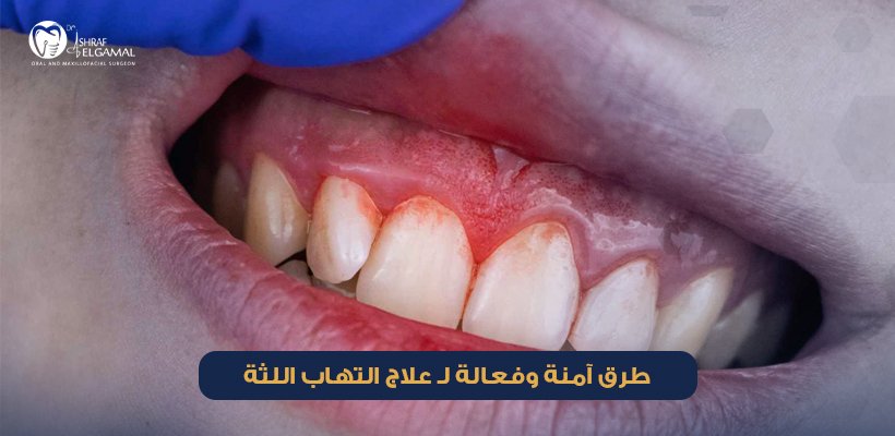 علاج التهاب اللثة