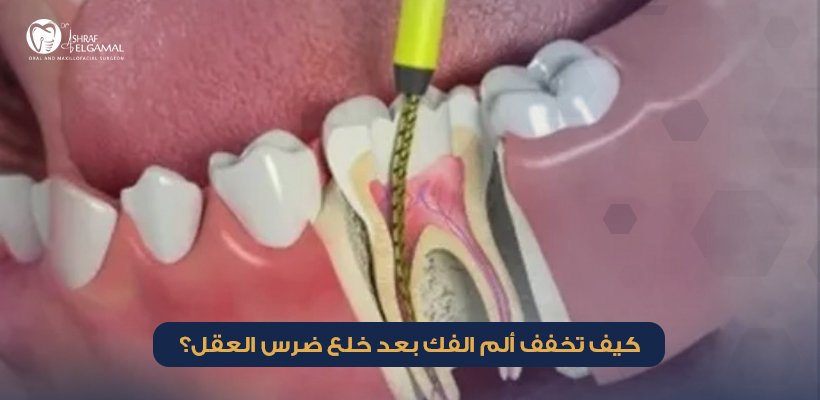 ألم الفك بعد خلع ضرس العقل