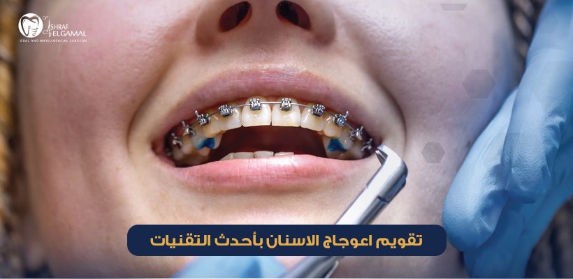 تقويم اعوجاج الاسنان