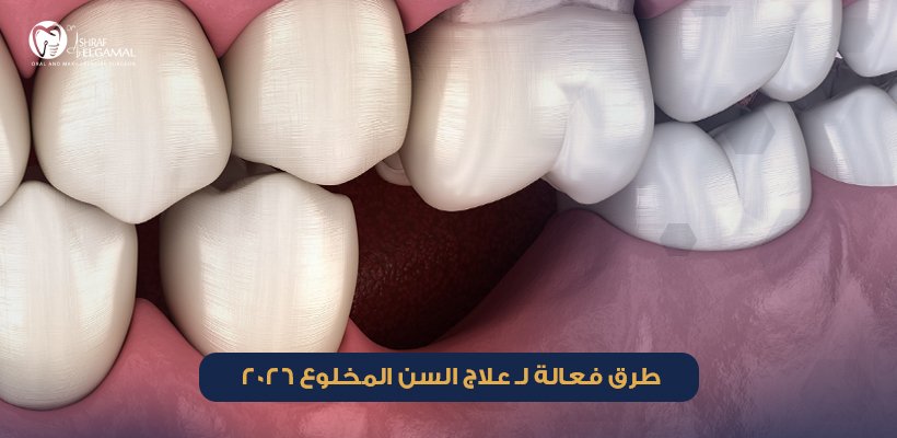 علاج السن المخلوع