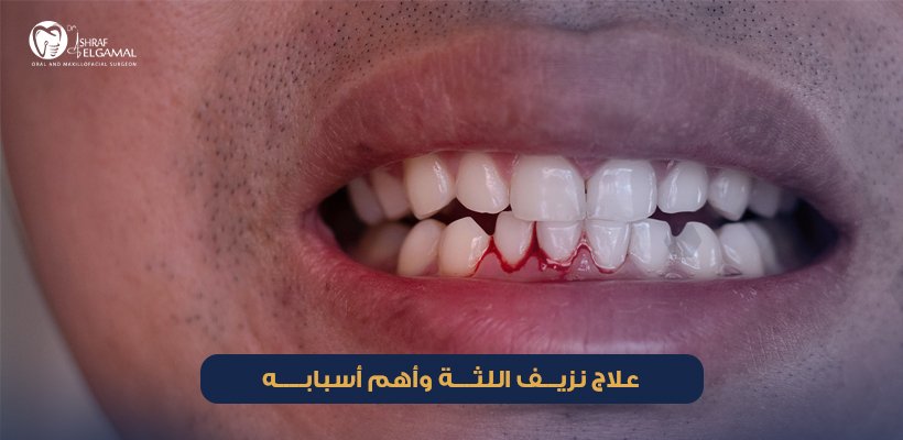 علاج نزيف اللثة
