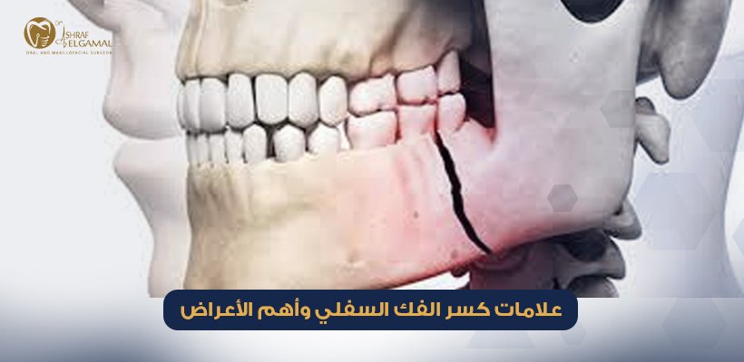 علامات كسر الفك السفلي