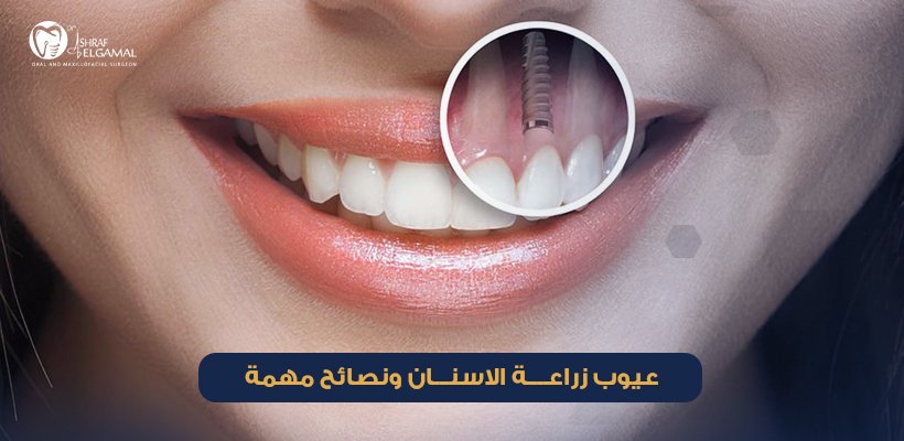 عيوب زراعة الاسنان