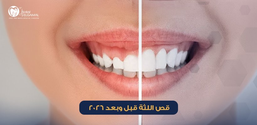 قص اللثة قبل وبعد