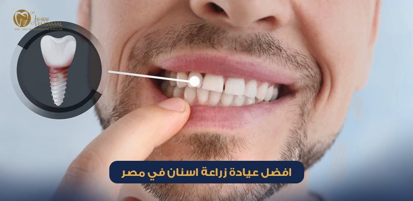 زراعة الاسنان في مصر
