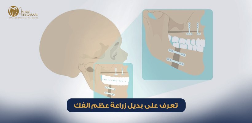 بديل زراعة عظم الفك