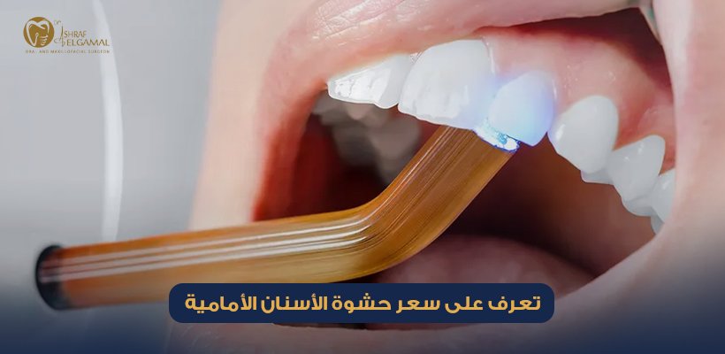 سعر حشوة الأسنان الأمامية