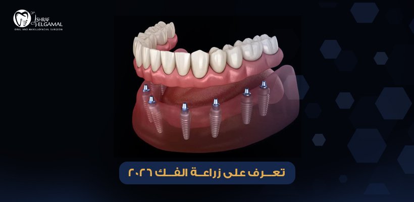زراعة الفك
