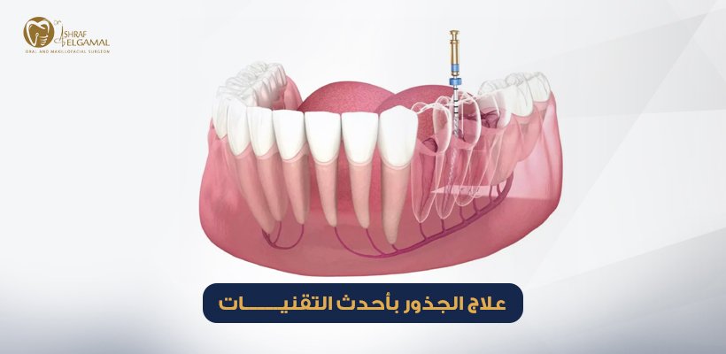 علاج الجذور