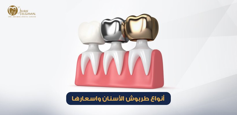 أنواع طربوش الأسنان واسعارها