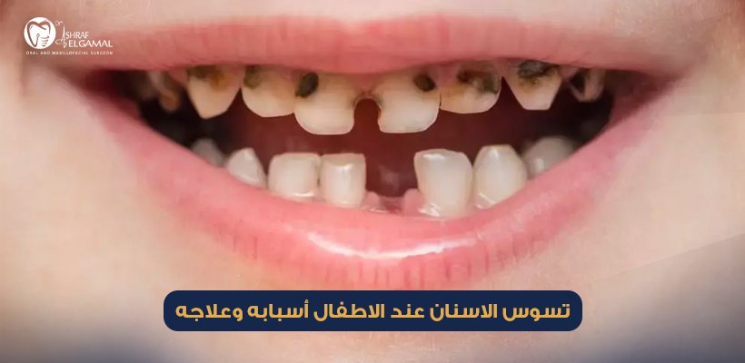 تسوس الاسنان عند الاطفال