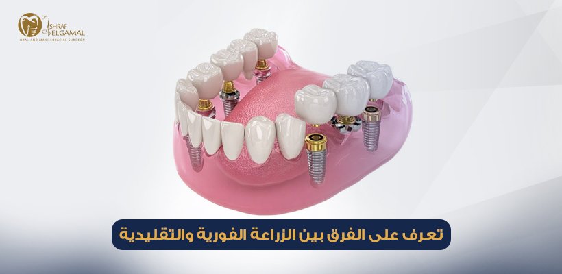 الفرق بين الزراعة الفورية والتقليدية
