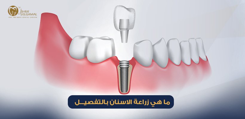 ما هي زراعة الاسنان