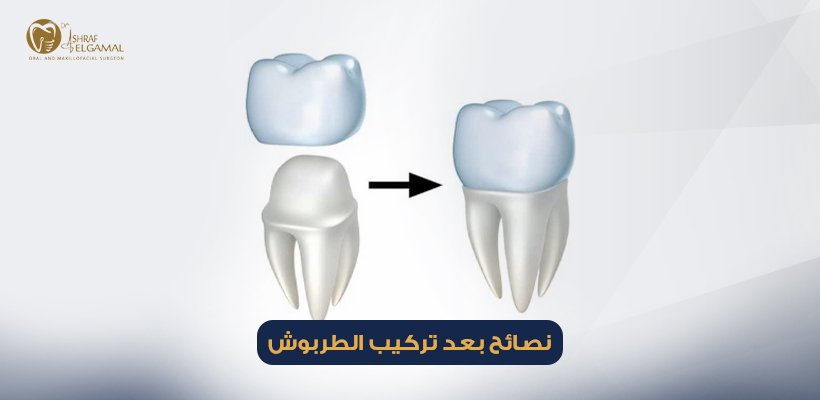 نصائح بعد تركيب الطربوش