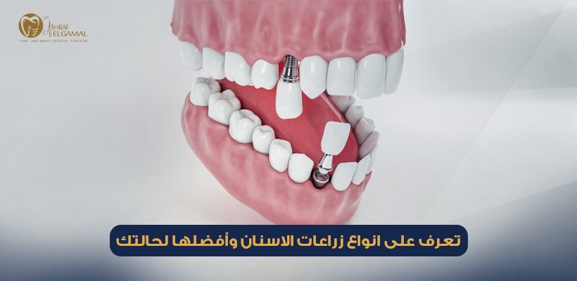انواع زراعات الاسنان
