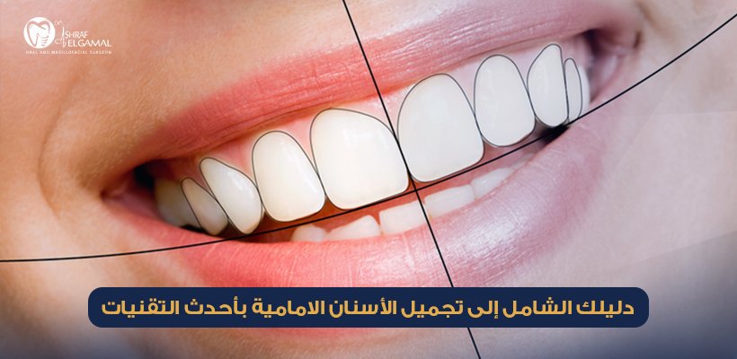 تجميل الأسنان الامامية
