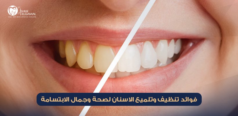 تنظيف وتلميع الاسنان