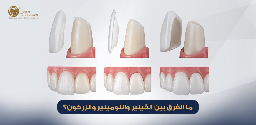 الفرق بين الفينير واللومينير والزركون