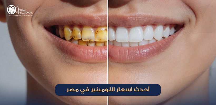 اسعار اللومينير
